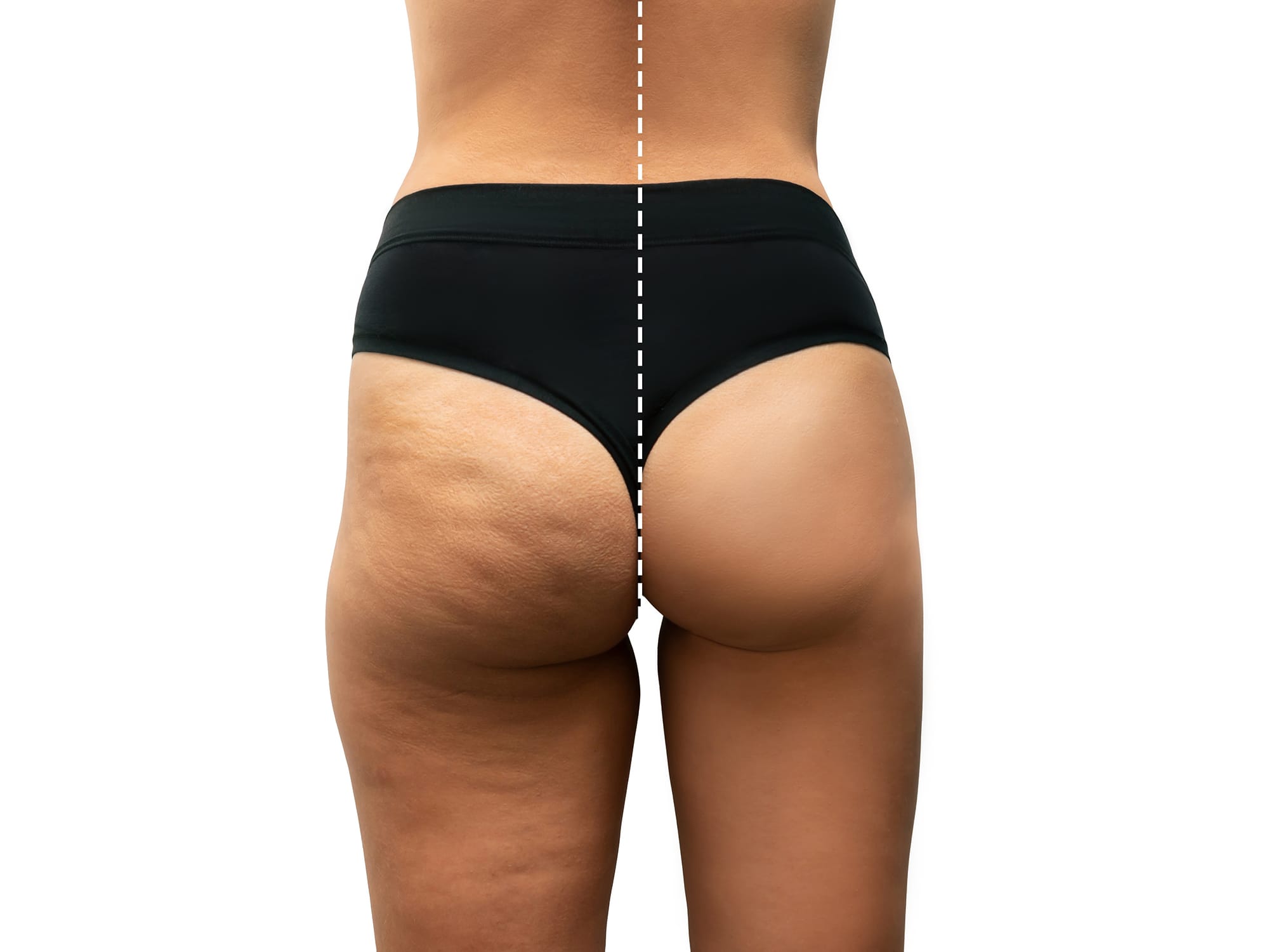 Cellulite reduction treatment for smoother body contours