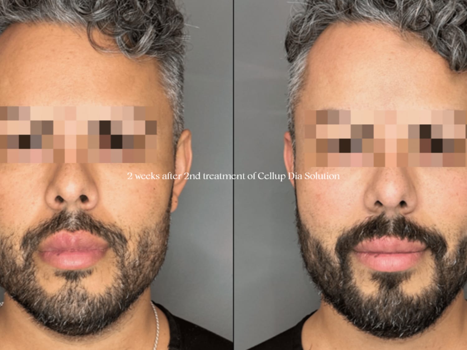 Target Cool Ice Needling at Globar