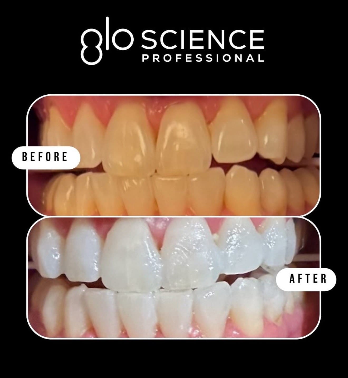 GLO take-home teeth whitening kit